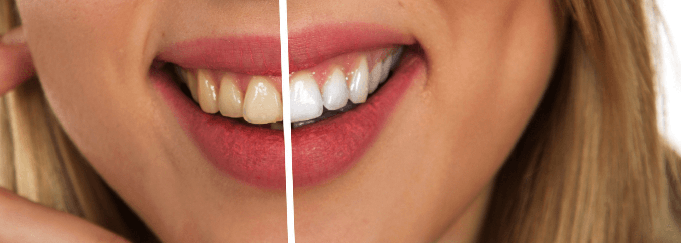 Descubra 5 mitos e verdades sobre clareamento dental
